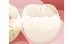 CRを固めるため光をあてているイラスト