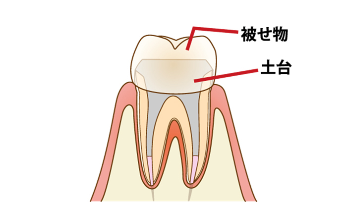 土台を入れた後の被せ物を被せたイメージ