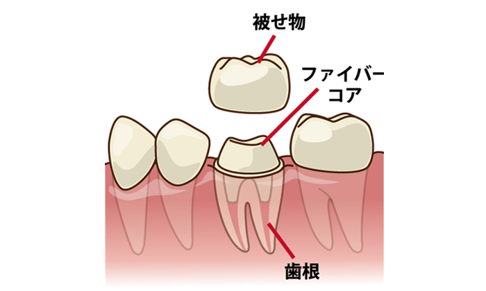 歯根・ファイバーコア・被せ物のイメージ