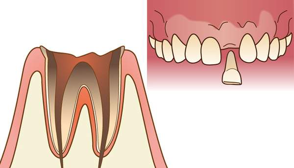 C4の虫歯のイラストと抜歯のイメージ