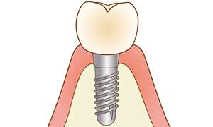 インプラントのイラスト