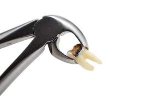 麻布十番歯科で虫歯を抜歯したイメージ写真