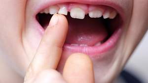 前歯が欠けた子供の歯