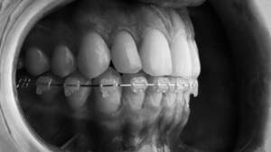 表側矯正で使用する矯正装置を装着した歯のイメージ