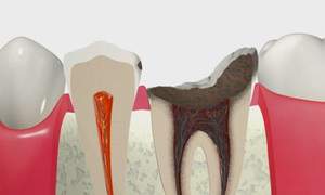 C4の虫歯が進行し健康な歯が残っていない状態の断面図