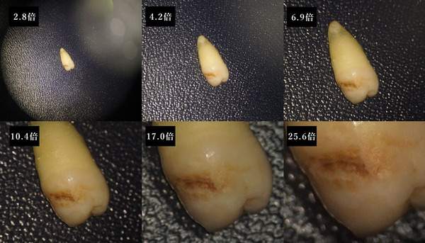 虫歯を発見するためのルーペを使用したときの虫歯の見え方の写真