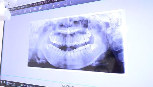 虫歯になりかけの段階の診査が難しいときに撮影するレントゲン写真