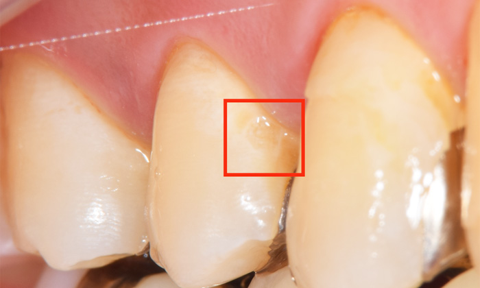 麻布十番歯科で虫歯部位を赤枠で囲った症例写真