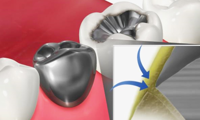 歯と詰め物の隙間に汚れが溜まっているイラスト