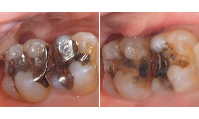 麻布十番歯科で銀歯が虫歯になってしまった症例の口腔内写真