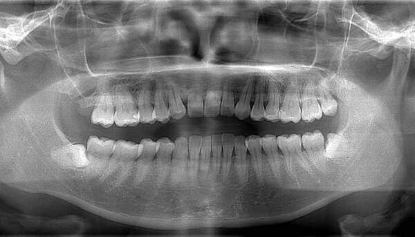 麻布十番歯科で親知らずのレントゲン画像のイメージ