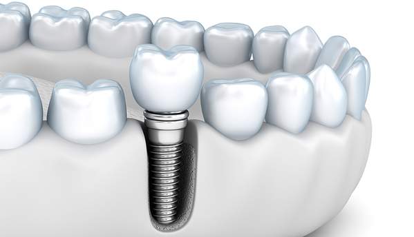 麻布十番歯科のインプラント治療のソケットプリザベーションのイメージ