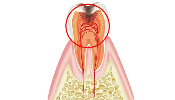 虫歯を放置した歯の断面図