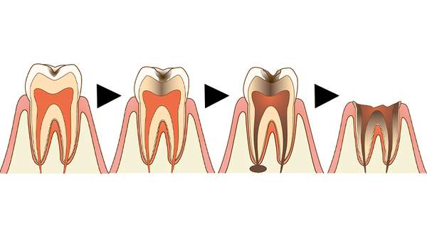 虫歯を放置した場合の経過の断面図のイラスト