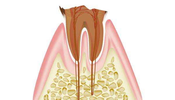 虫歯を3年放置した歯の断面図