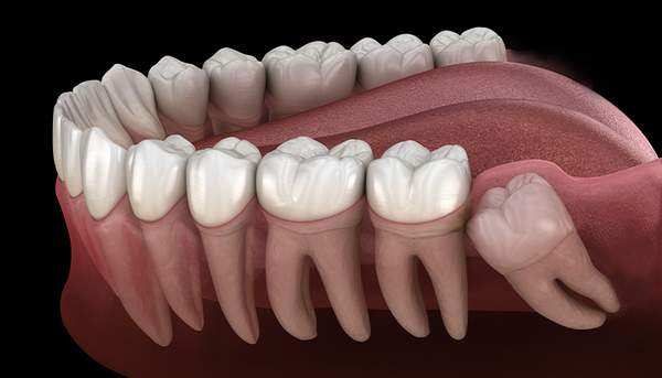 埋伏抜歯（親知らずなど）
