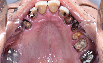 麻布十番歯科で虫歯を3年放置した方の上顎の症例写真