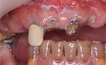 麻布十番歯科で虫歯を10年放置した方の上顎の症例写真