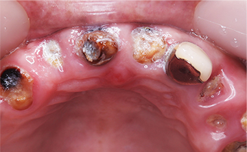 麻布十番歯科で虫歯を10年放置した方の下顎の症例写真