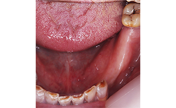 麻布十番歯科で虫歯を10年放置し歯が無くなった症例写真