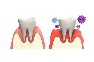 歯周病を放置した場合の歯ぐきの状態のイラスト