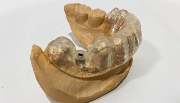 インプラントで後悔