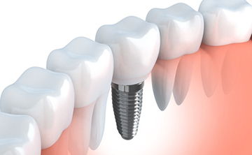 治療方法3：インプラント