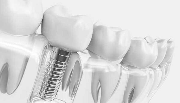 麻布十番の歯医者さんのインプラント埋入のイメージ