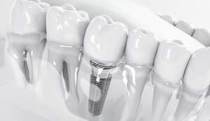 当院インプラント治療の費