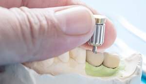 インプラントの仮歯