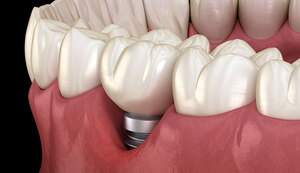 インプラント周囲炎