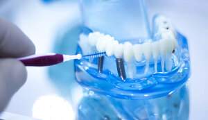 インプラント治療後の定期検診