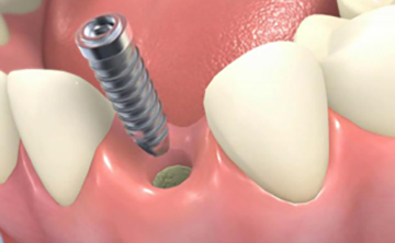 インプラントの素材