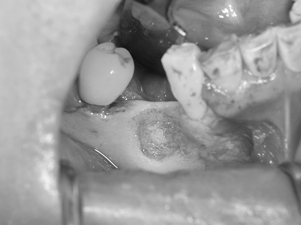 麻布十番歯科のインプラント予定部位の骨の状態の症例写真