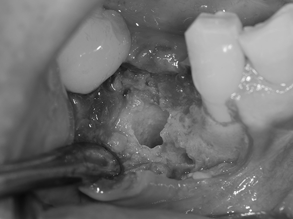 麻布十番歯科のインプラント手術の症例②