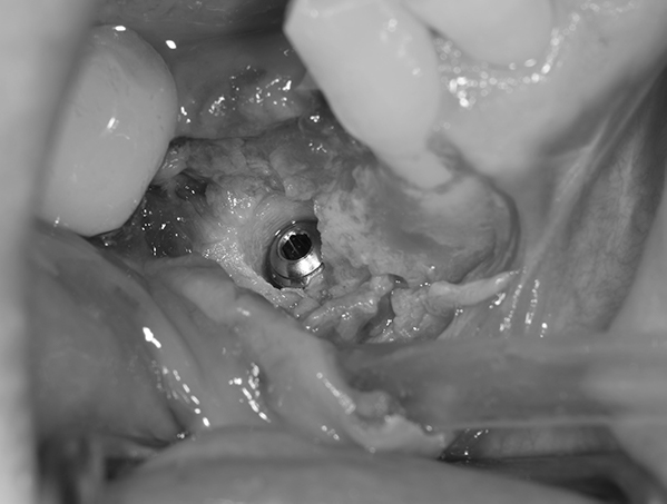 麻布十番歯科のインプラント手術の症例③