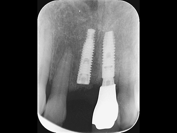 麻布十番歯科の左右で異なるインプラント体を使用したレントゲン写真