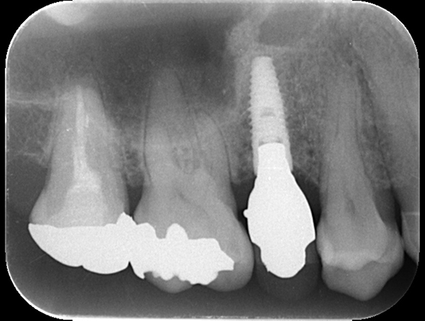 麻布十番歯科のソケットリフト手術後のレントゲン写真