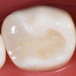 セラミックインレー