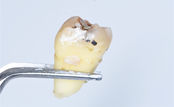 軽度（C1）の虫歯で抜歯後の歯の写真