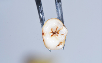初期虫歯の状態の抜歯後の歯の写真