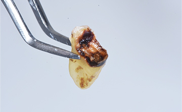 虫歯を放置した場合の抜歯後の歯の写真