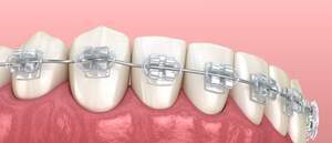 麻布十番歯科の矯正治療でワイヤー矯正を行っている歯のイメージ