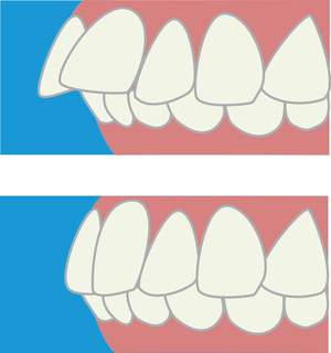 通常の歯並びと出っ歯の場合を比較したイラスト