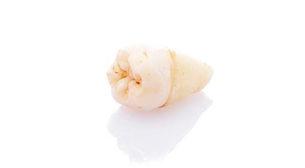 親知らずの抜歯した歯のイメージ写真