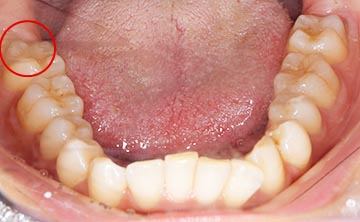 麻布十番歯科で親知らずが横向きに生えて歯ぐきが腫れている症例の口腔内写真のイメージ