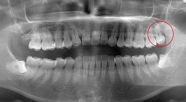 麻布十番歯科で親知らずが真っ直ぐ生えている症例のレントゲン写真のイメージ