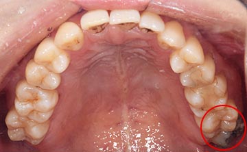 麻布十番歯科で親知らずが真っ直ぐ生えている症例の口腔内写真のイメージ