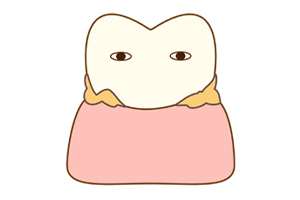 歯間に汚れが溜まっている歯のイラスト