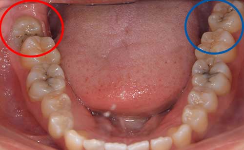 麻布十番歯科の虫歯になっている親知らずと斜めに生えた親知らずの症例イメージ